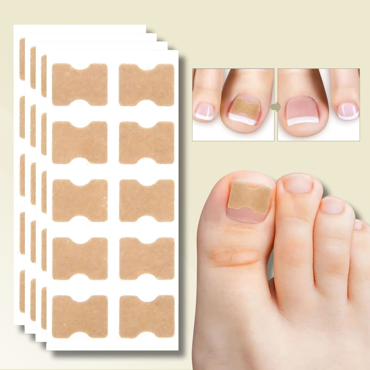 Fungi Nail Patches for Instant Relief from Ingrown Nails and Nail Fungus – 10 Count 0