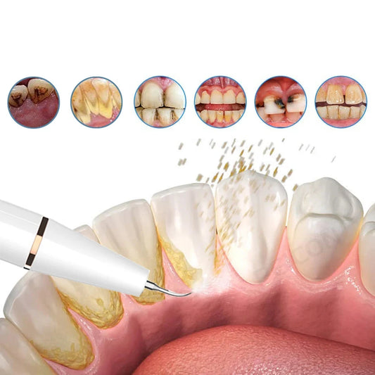FreshScale – Ultraschall-Plaque- und Zahnstein-Entferner