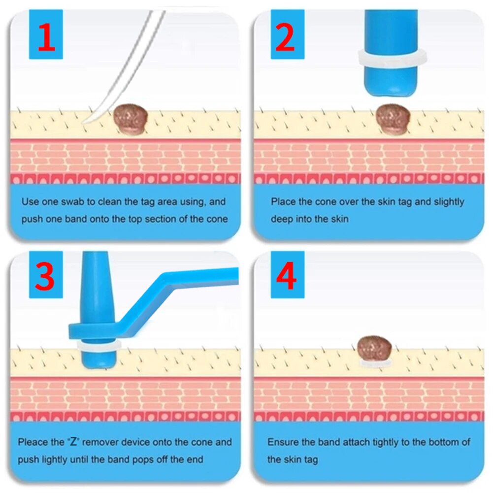 Skin Tag Removal Kit - 2-in-1 Silicone Band Ligation System for Safe Home Use-5