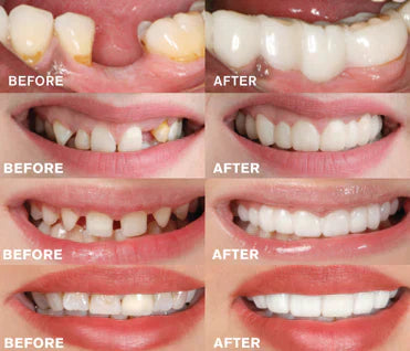 BrightBite - EasyClick Zahnprothese
