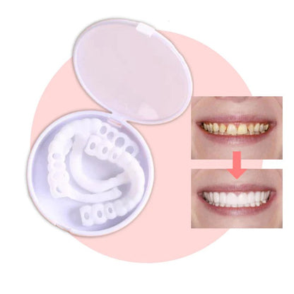 Vivolux | SmileSnap - Always the perfect smile with these veneers 0