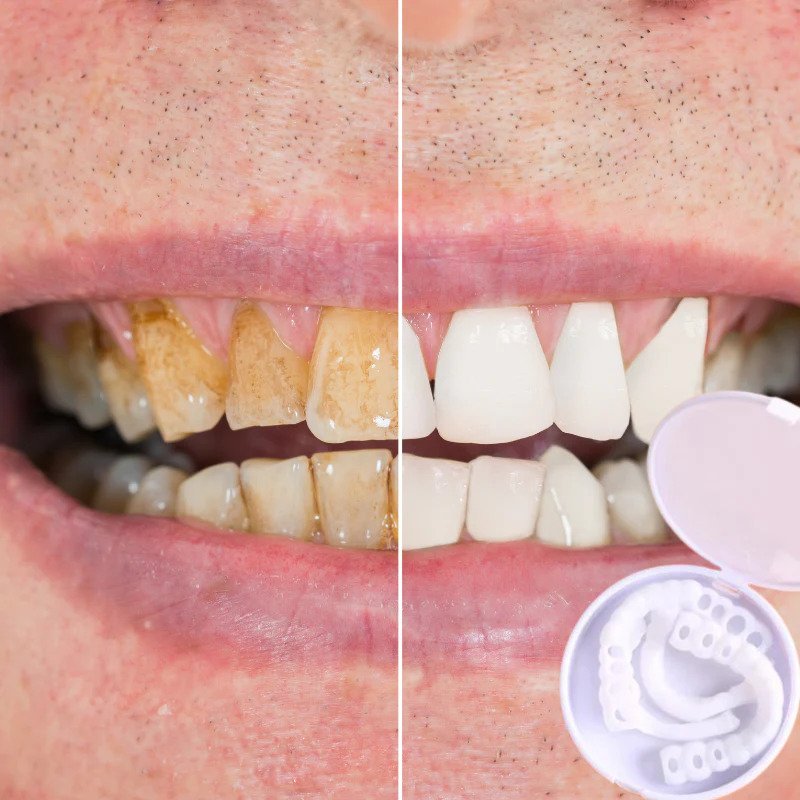 Vivolux | SmileSnap - Always the perfect smile with these veneers 3